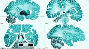 bigbrain_a3d_oblique